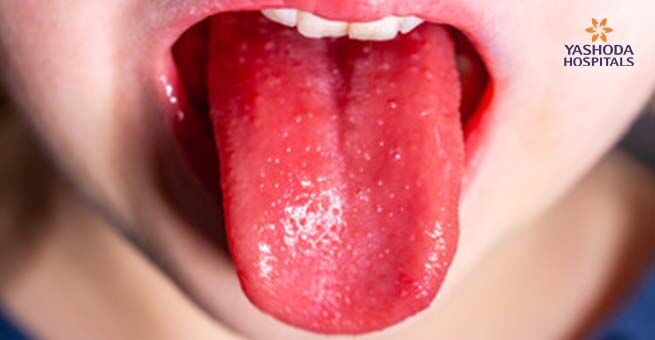 Kawasaki disease