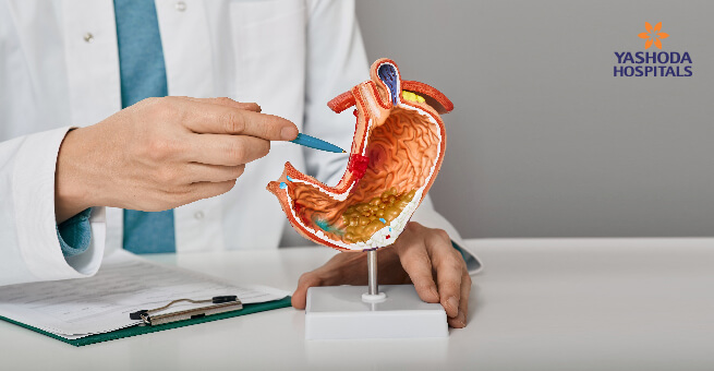 Peptic Ulcer Disease2