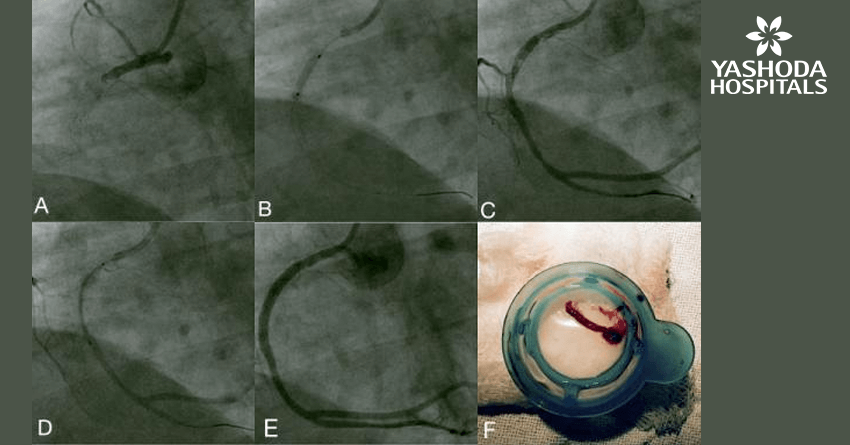 Primary angioplasty for Acute Myocardial infarction