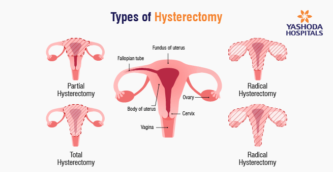 Robotic Surgery Transforms Gynecological Healthcare_Body 2