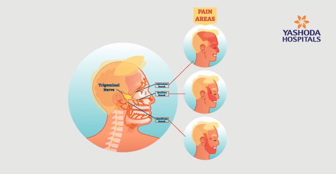 Trigeminal Neuralgia tratment in yashoda
