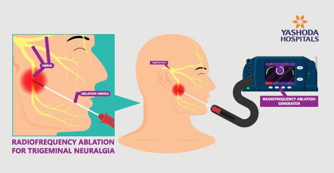 Trigeminal Neuralgia tratment in yashoda
