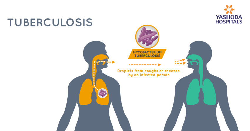 How does a person become infected with tuberculosis