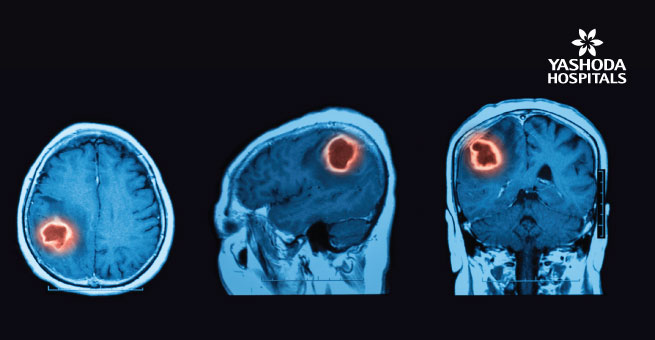 Tumor in the brain, means brain cancer