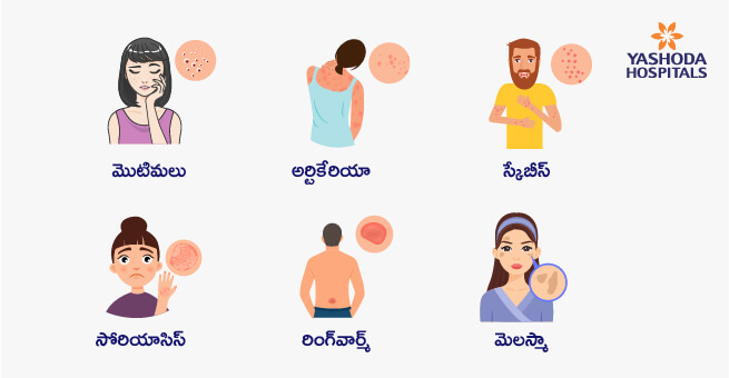 Types of Skin Diseases and Precautions to be taken for Skin Care1