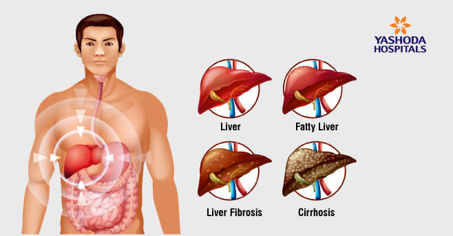 Viral Hepatitis