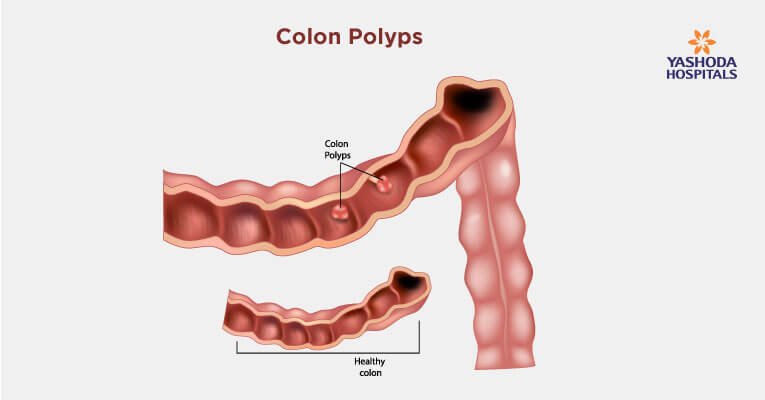What are colon polyps