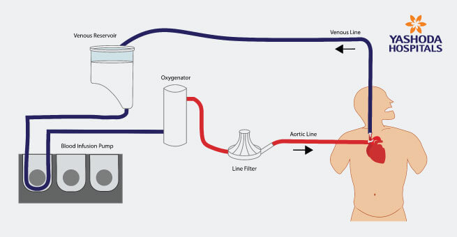 What does ECMO support do