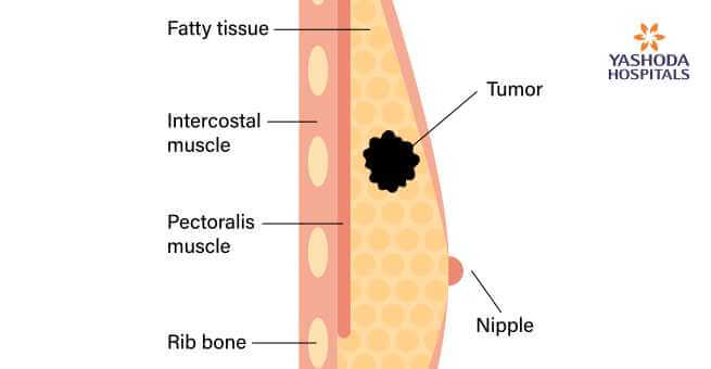 Where does Breast Cancer start