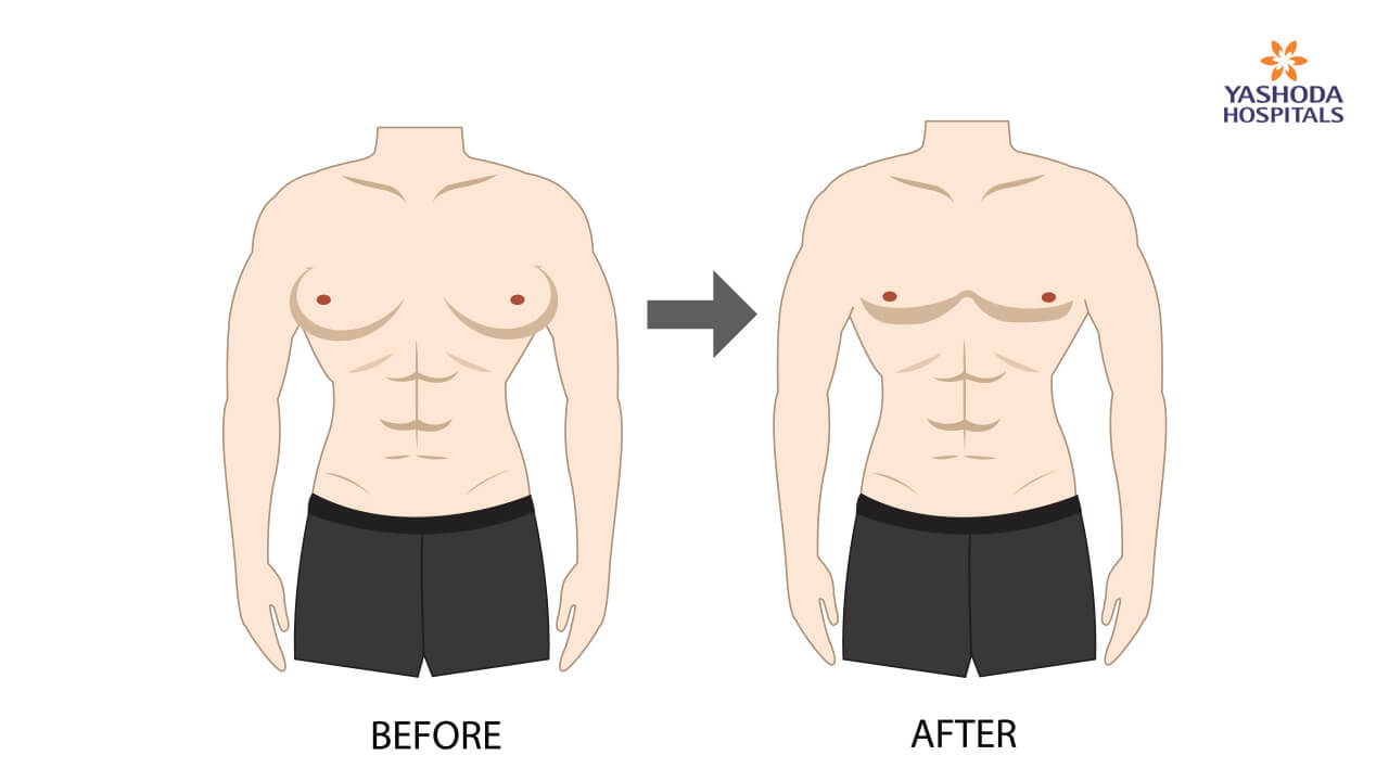 Why does gynecomastia need treatment