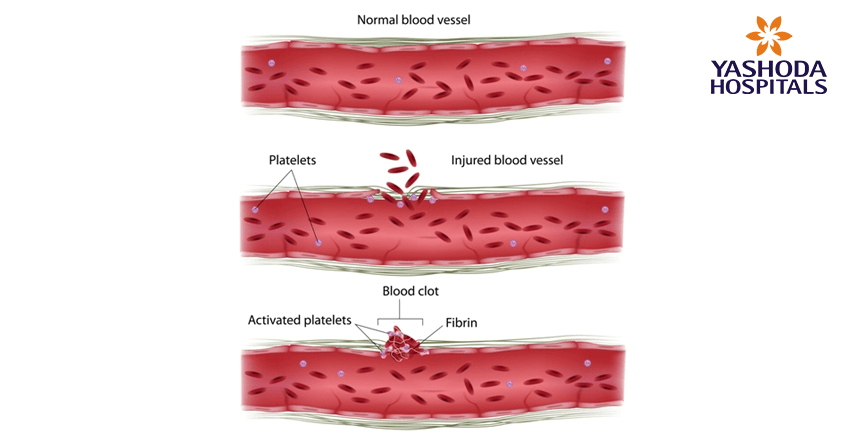 Primary angioplasty for Acute Myocardial infarction