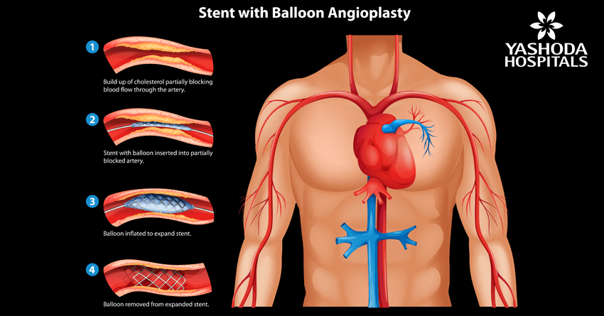 Primary angioplasty for Acute Myocardial infarction