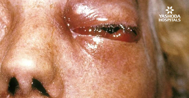 deformities due to black fungus infection
