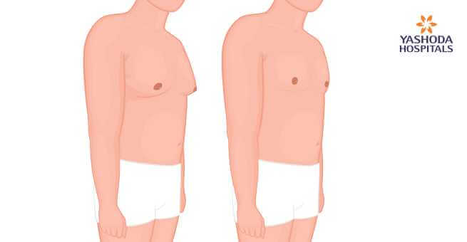 Breast Cancer symptoms 