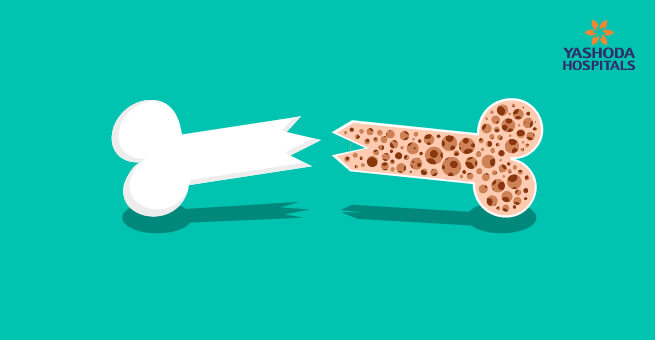 osteoporosis-body2