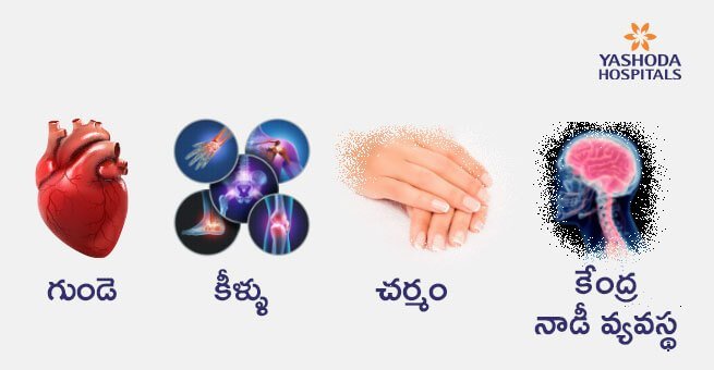 rheumatic fever affects 