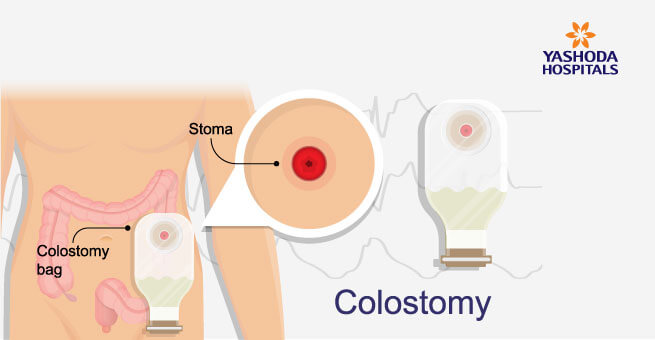 surgical approach for colon cancer