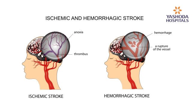 the types of stroke