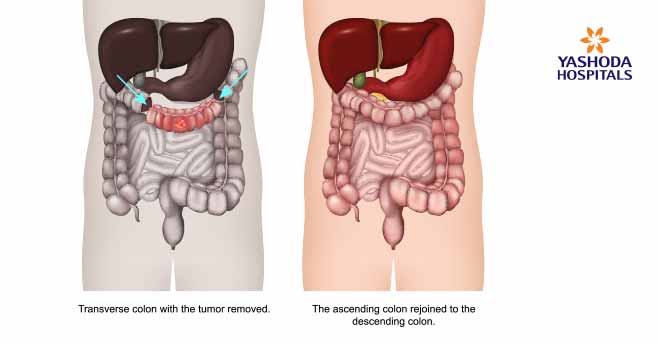 transverse colectomy