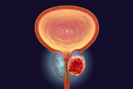 What is prostate cancer?