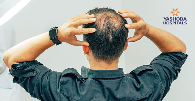 young-man-bald spot office trichologist